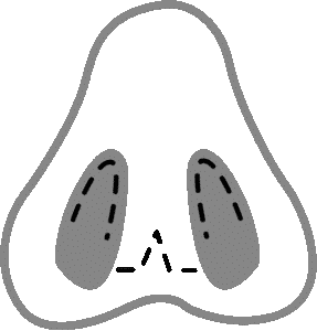 1753896501_open-rhinoplasty