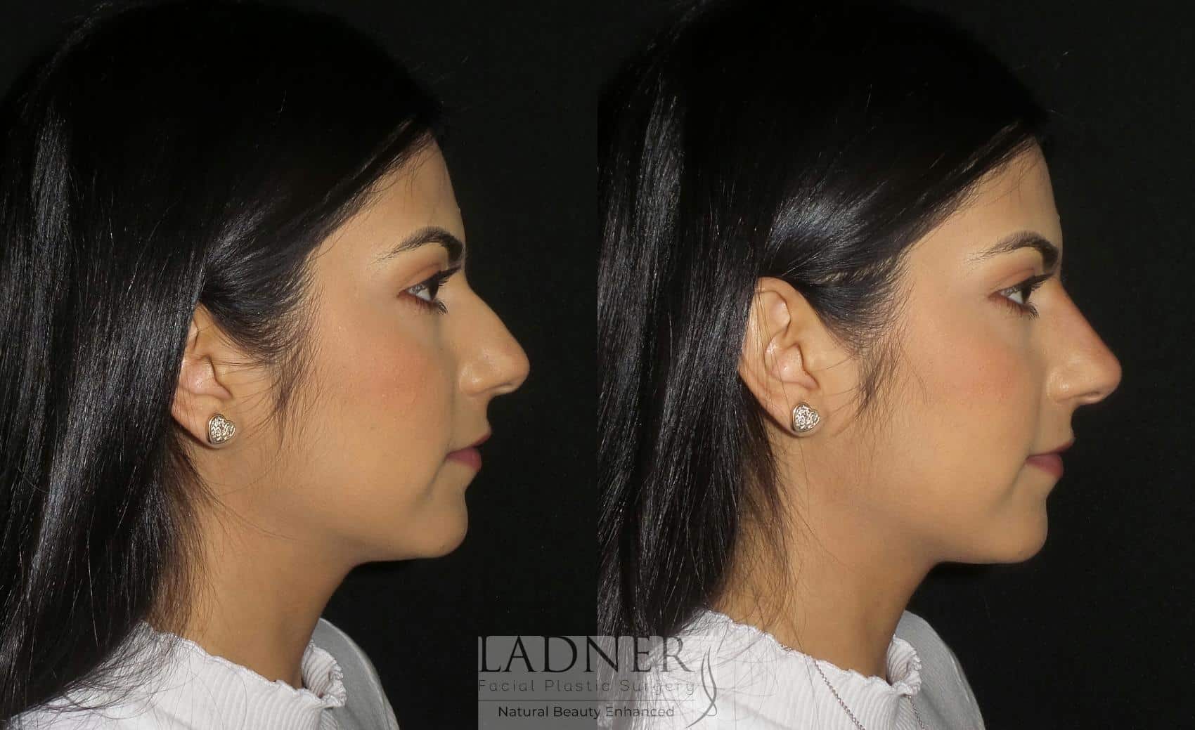 before and after Nose Surgery Beverly Hills CA
