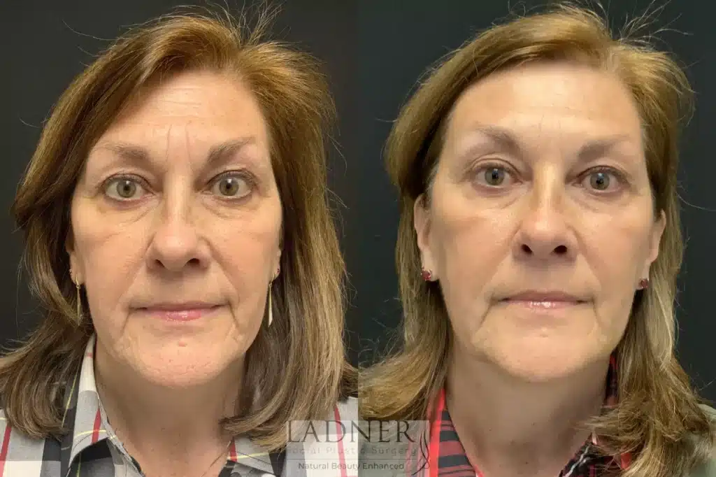 dermal-fillers-143-front-detail before and after Dermal Fillers Denver CO