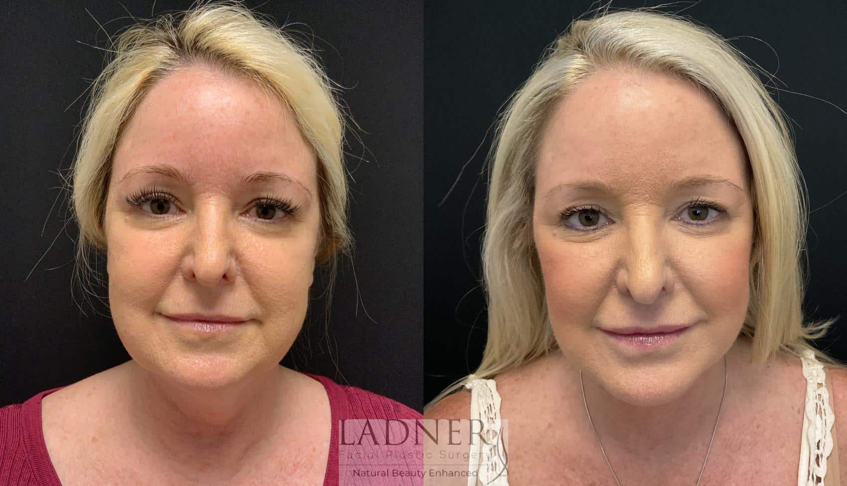 Deep Plane Facelift / Neck Lift Case 164 Before & After Front | Denver, CO | Ladner Facial Plastic Surgery